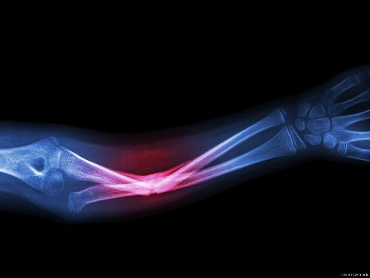 Bone Fractures Are More Common in HIV-Positive People 
