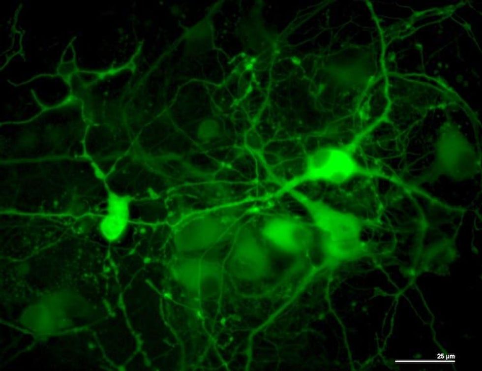 HIV Lies Dormant In Brain, Increasing Risk of Dementia