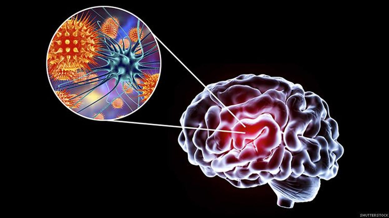 HIV Lies Dormant In Brain, Increasing Risk of Dementia
