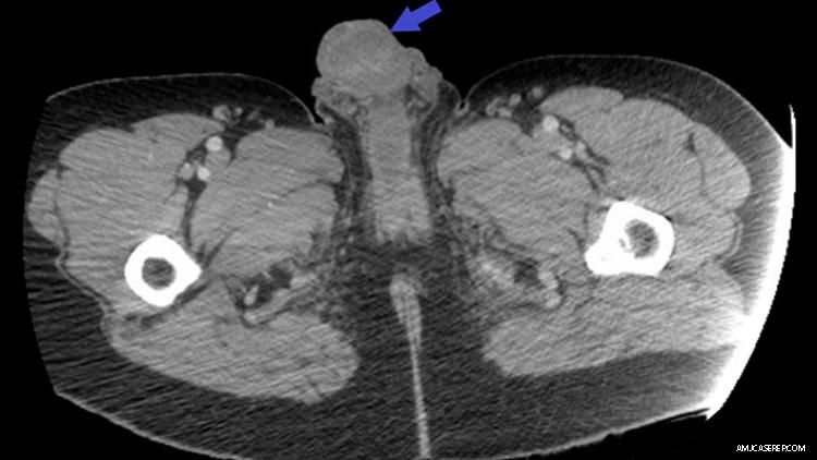 Man Injects Cocaine Into Penis, Suffers Inevitable Results