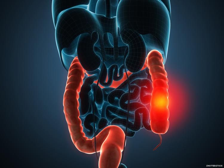 Colorectal Cancer Rates on The Rise in Younger People