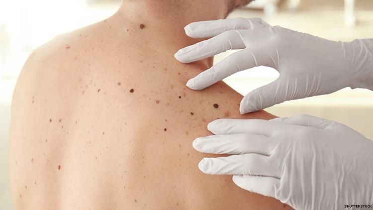 Researchers Can Now Detect Melanoma At Earlier Stages 